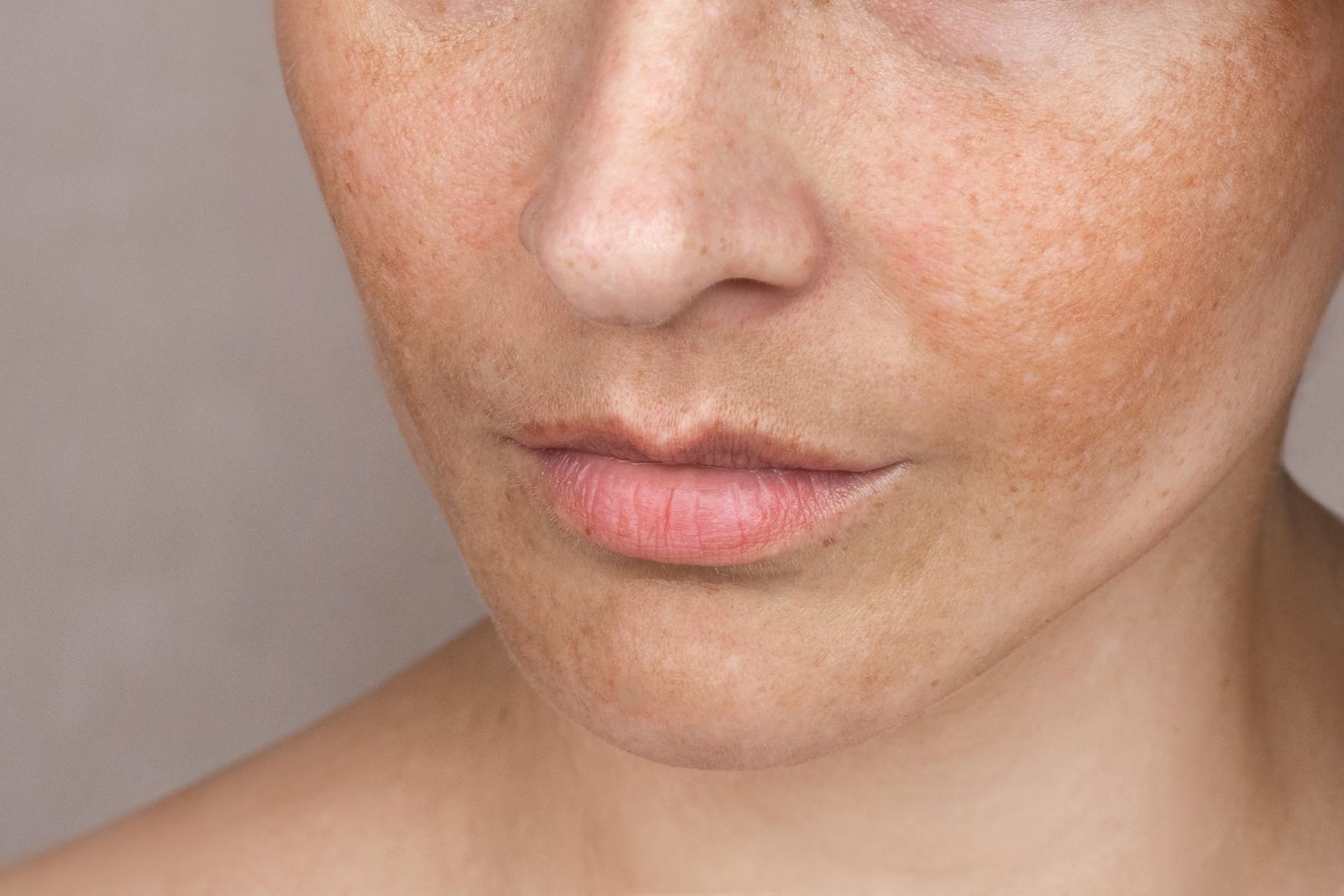 Nahaufnahme einer von Melasma betroffenen Hautstelle im Gesicht einer Frau